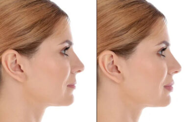 Blog 7 The Truth About Dermal Fillers: What They Do and How They Work