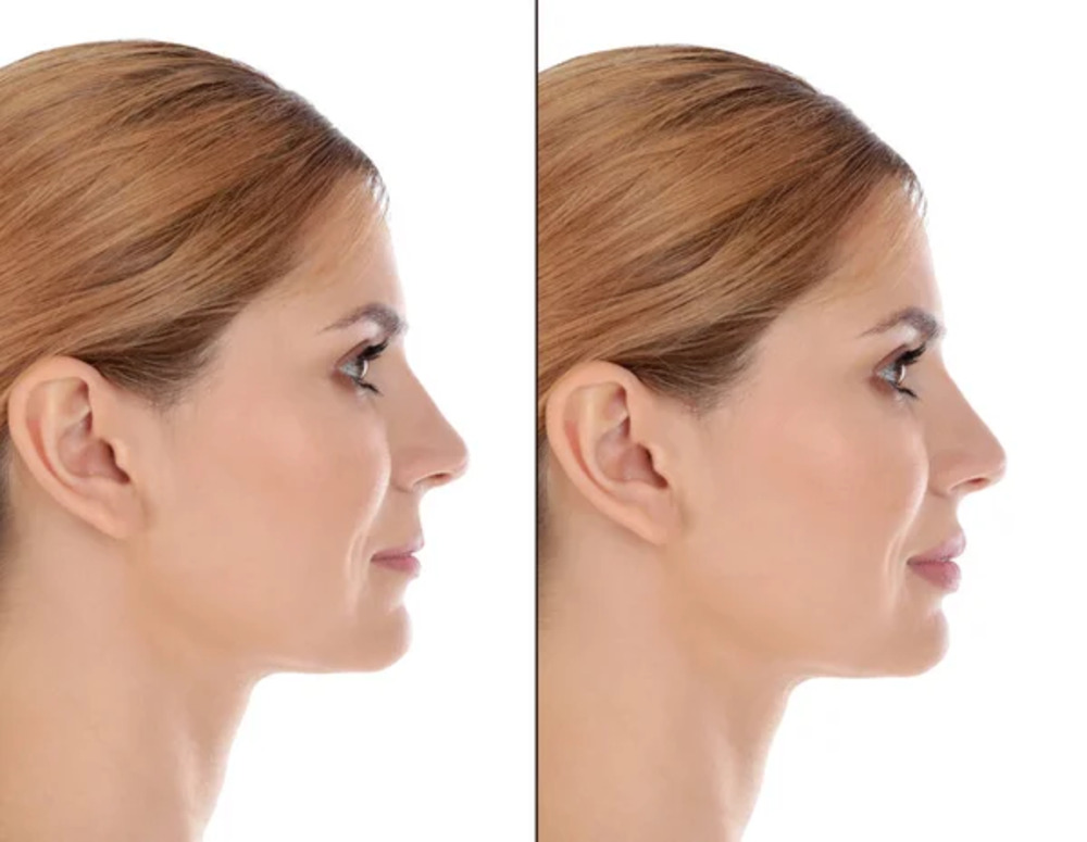 Fillers (Juvaderm, Sculptra) Small 1 Fillers Juvaderm Sculptra Small 1