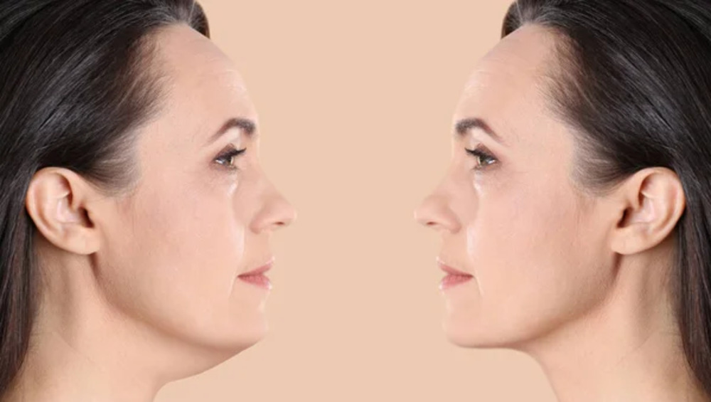 Fillers (Juvaderm, Sculptra) Small 2 Fillers Juvaderm Sculptra Small 2