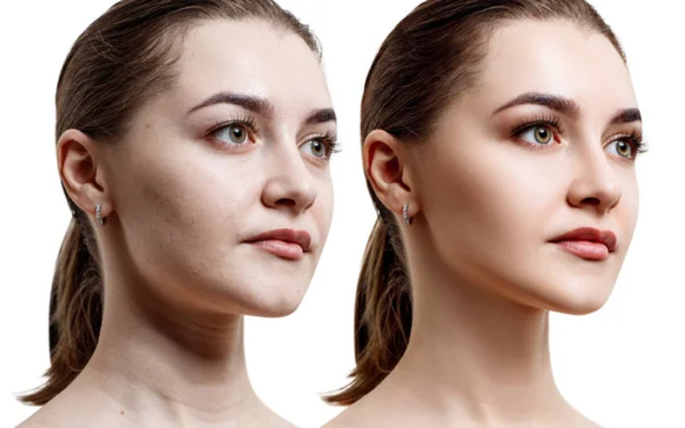 Fillers (Juvaderm, Sculptra) Small.3 jpg Fillers Juvaderm Sculptra Small.3 jpg