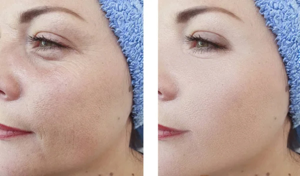 Fillers (Juvaderm, Sculptra) Small Fillers Juvaderm Sculptra Small