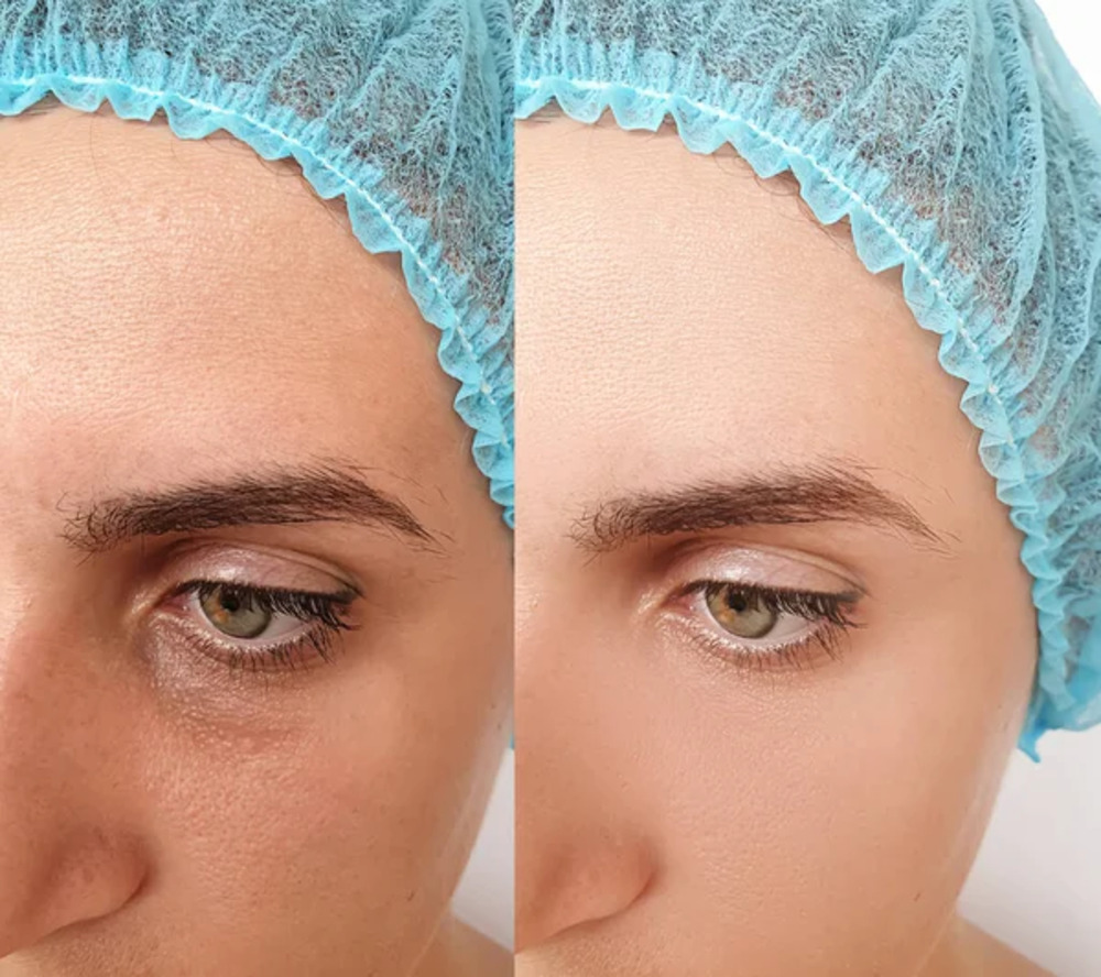 Microneedling Rejuvapen NXT Small 2