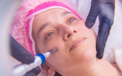 Blog 6 Why Microneedling is the Secret to Healthier, Younger-Looking Skin