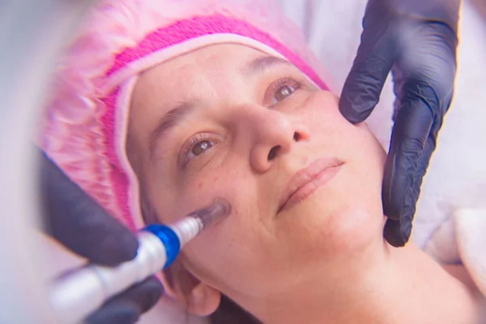 Microneedling Rejuvapen NXT Small 3