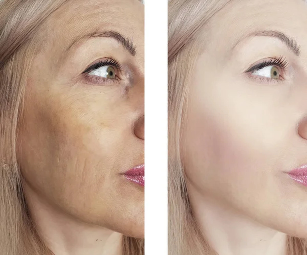 Toxins Botox and Jeuveau Small.3 jpg