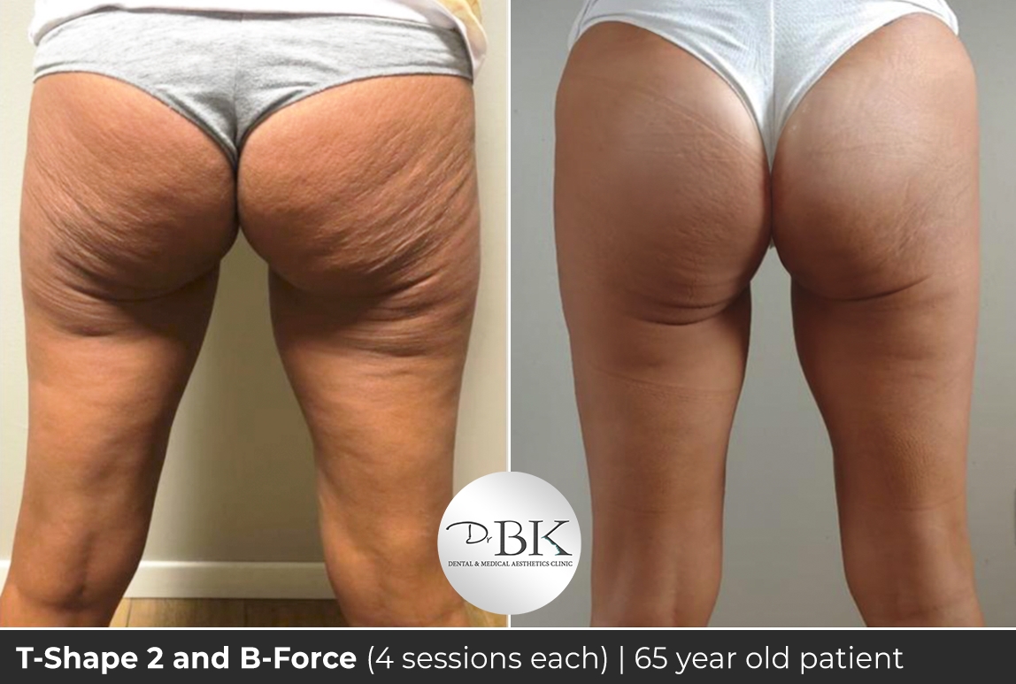 Tshape and bforce 65 year old copy