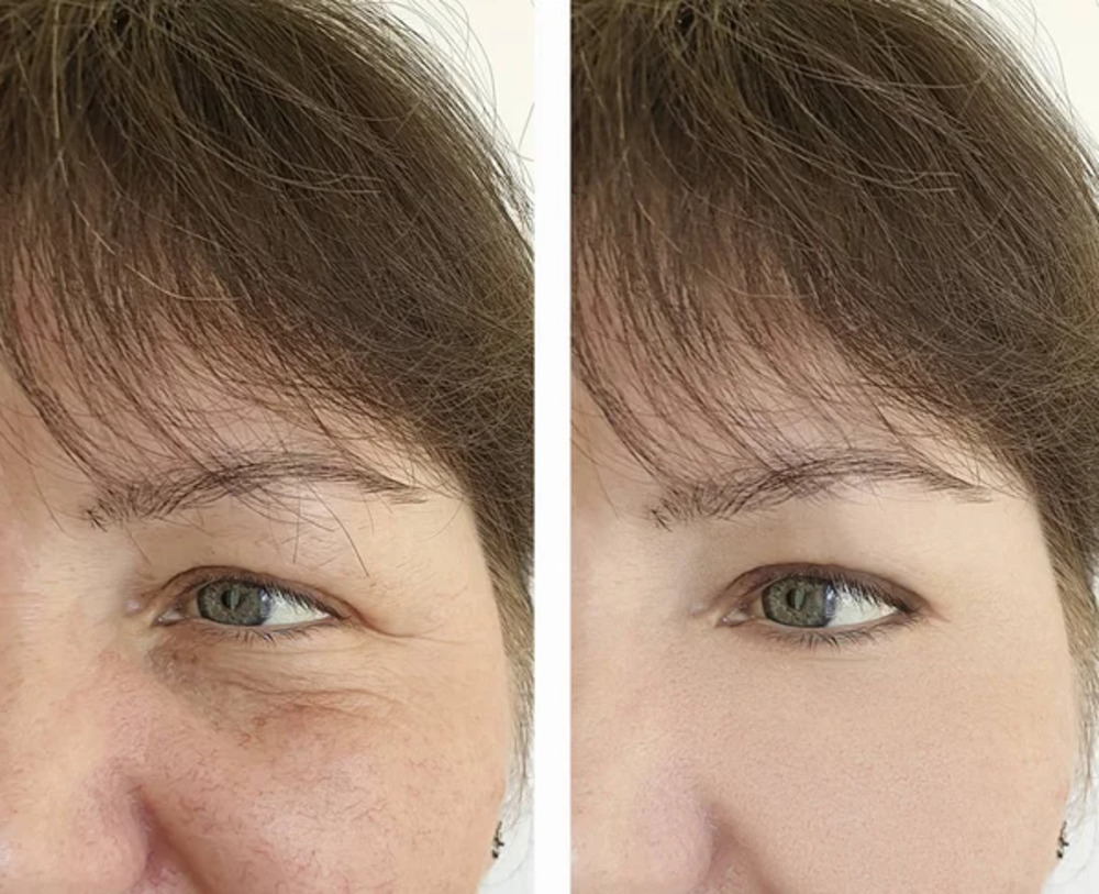 lumecca IPL Small.2jpg