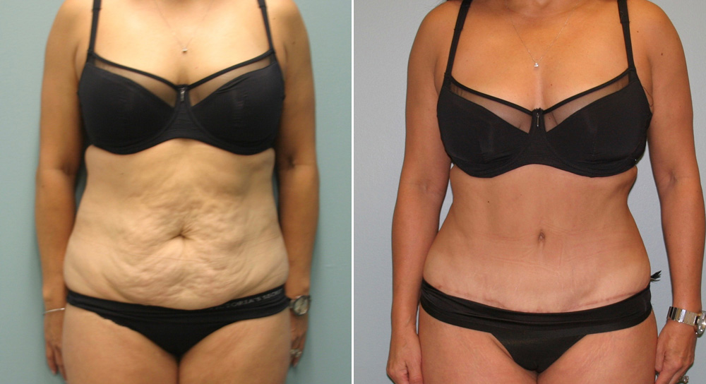 1.Abdominoplasty Front E